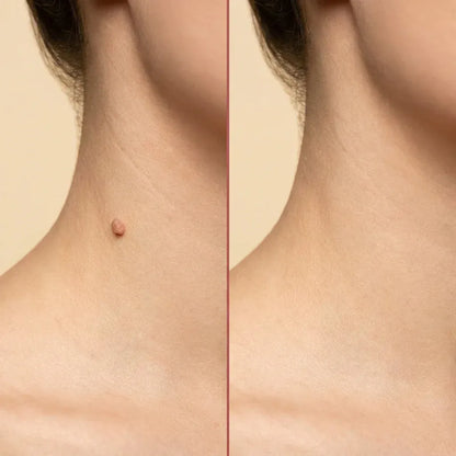DermaSmooth™ – Skin Tag Remover for Gentle & Easy At-Home Removal